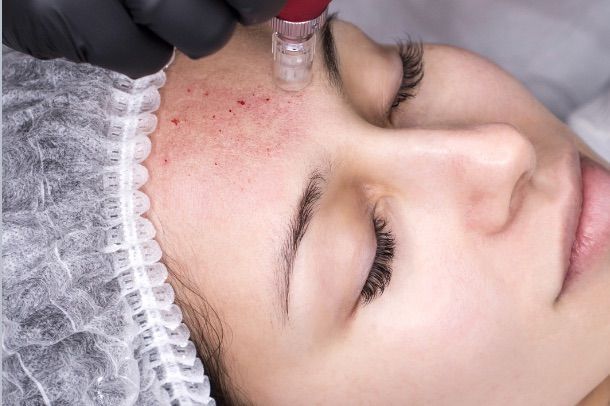 Mezoterapia nanoigłowa — Joanna Lange Kosmetyka
